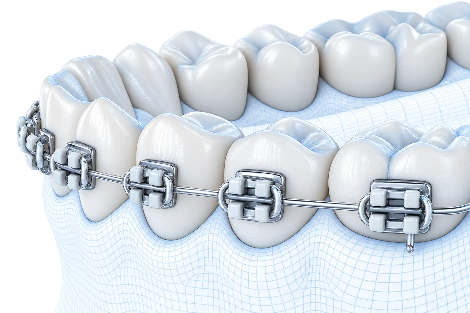 Fixed orthodontic appliance on a modelled lower arch